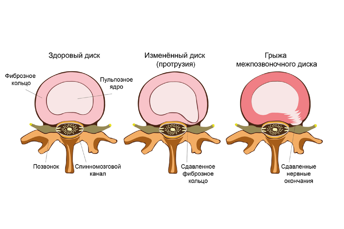 Фиброзное кольцо межпозвоночного диска